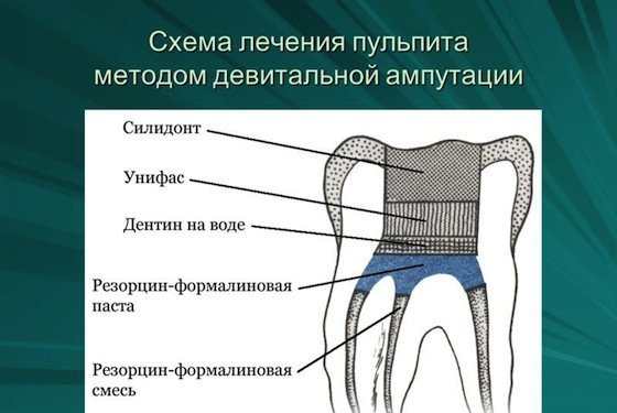 Пульпит зуба: симптомы, причины, лечение