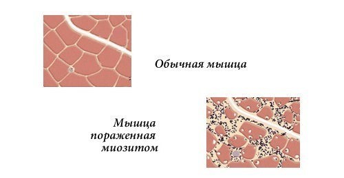 Покалывание в верхней части грудной клетки