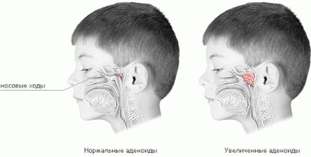 Аденоиды у детей клинические симптомы и лечение