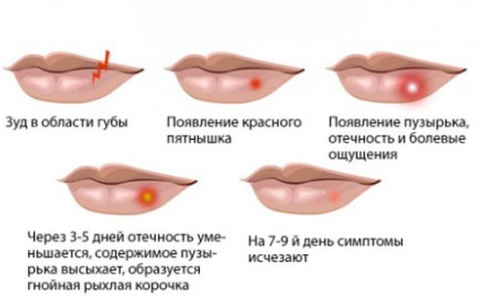 Герпес на губах - причины, признаки, симптомы, лечение