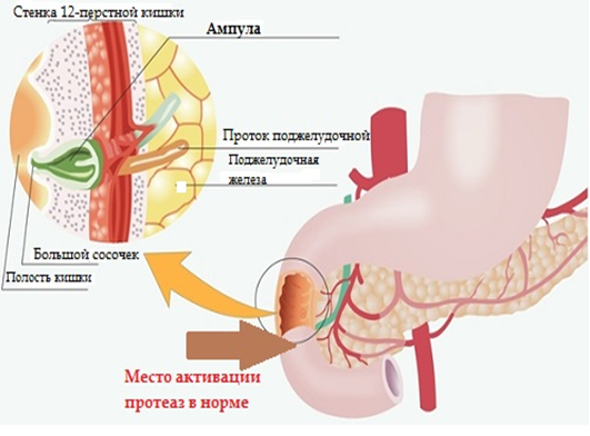 Панкреонекроз поджелудочной железы – операция, лечение