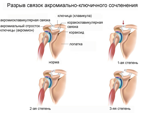 Боль в ключице, болит правая или левая ключица
