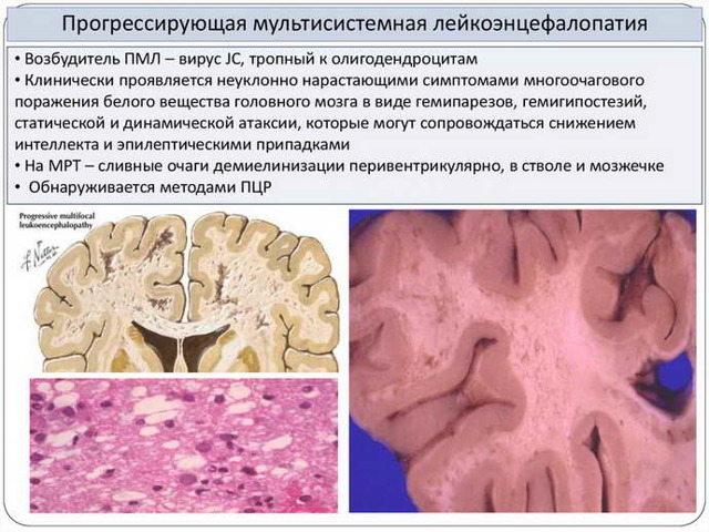 Лейкоэнцефалопатия головного мозга что это такое