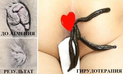 Лечение геморроя пиявками в домашних условиях