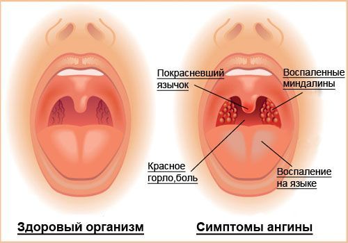 Виды ангины у детей: причины, симптомы