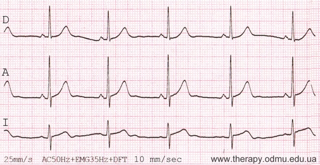 Стандартные отведения от конечностей - 1,2,3