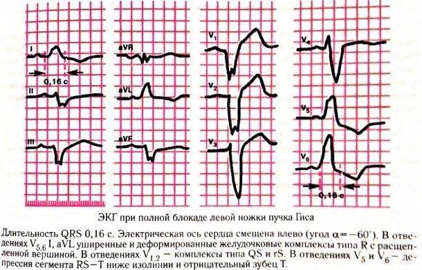 Неполная блокада левой ножки пучка Гиса - причины, лечение