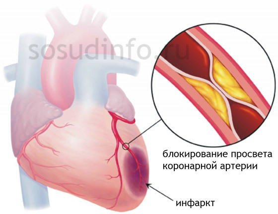 Симтомы, диагностика и лечение закупорки кровеносных сосудов