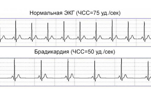 Сердечный гликозид для эффективного лечения хронической сердечной недостаточности