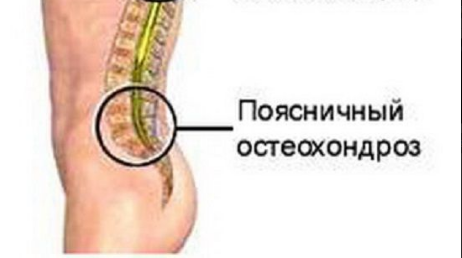 Экстрасистолия при остеохондрозе - что это такое и как лечить