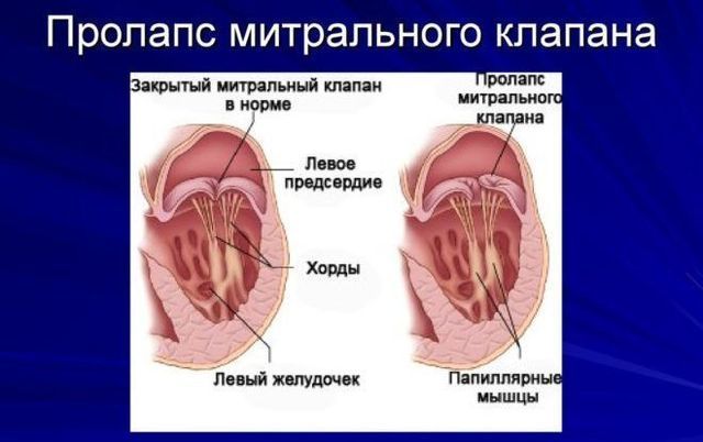 Пролапс митрального клапана 2 степени