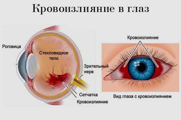 Кровоизлияние в глаз - что капать, какие глазные капли