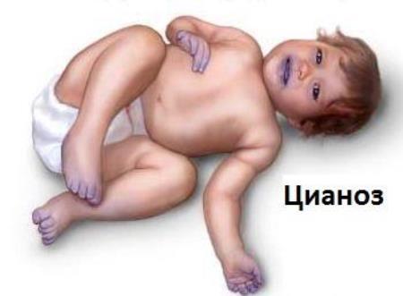 Врожденный порок сердца у новорожденных детей: что это, причины, последствия, классификация и лечение