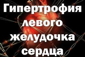 Гипертрофия левого желудочка сердца: признаки на ЭКГ и лечение