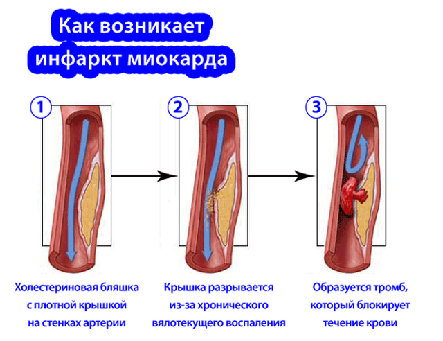 Инфаркт миокарда: что это такое, симптомы, лечение, последствия