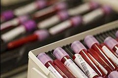 Анализ крови при лейкозе. Какие изменения в крови вызывает лейкоз. Биохимический анализ крови.