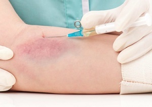 Флебит вены на руке. Лечение постинъекционного флебита после катетера