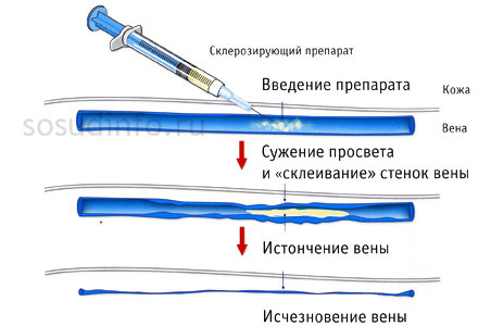 Почему видны вены на руках и как их убрать?