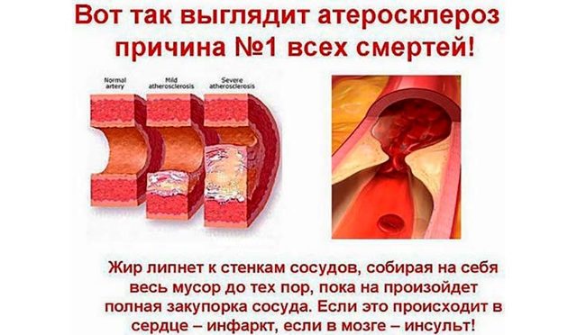 Медикаментозное лечение атеросклероза сосудов головного мозга препаратами