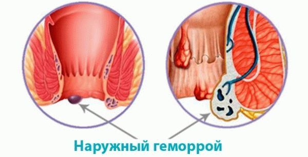 Удаление геморроидальных узлов с помощью разнообразных методик