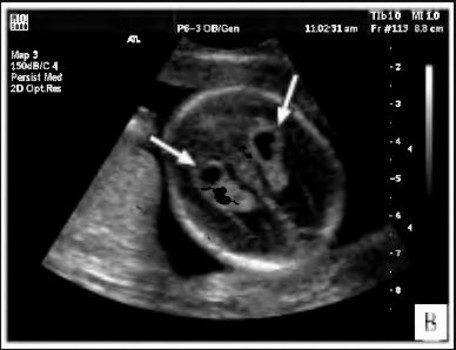 Киста сосудистого сплетения головного мозга: возникновение, диагностика, лечение. Опасна ли киста сосудистого сплетения для новорожденного?