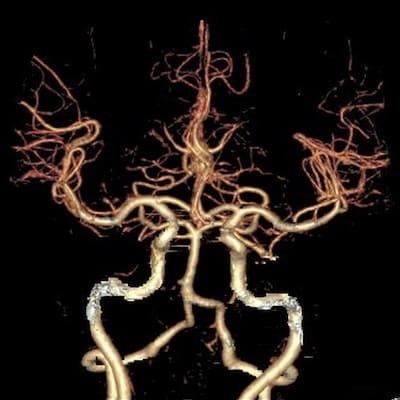 УЗДГ или МРТ: что лучше для обследования сосудов шеи?