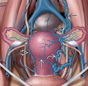 Варикозное расширение вен малого таза – симптомы, лечение и причины