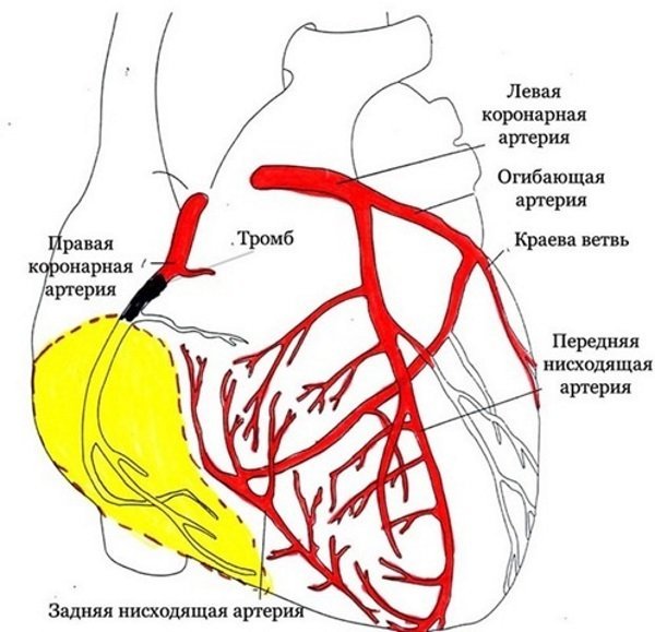 Инфаркт задней стенки сердца прогноз - Всё о сердце
