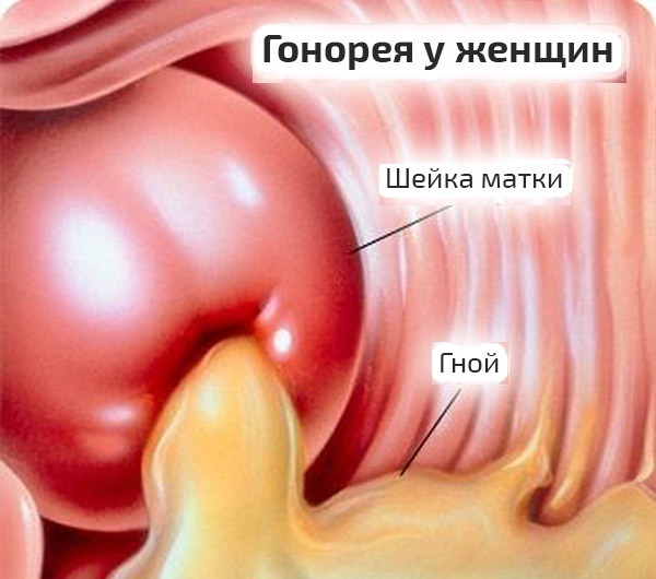 Гонорея у женщин – первые признаки, симптомы и лечение
