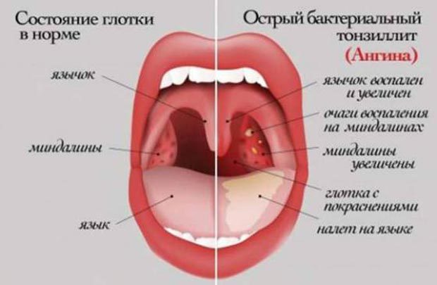 Тонзиллит: виды, фото, лечение и симптомы