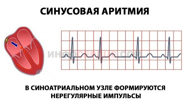 Миграция водителя ритма по предсердиям: что это такое, симптомы и лечение