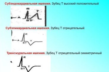 Расшифровка ЭКГ — норма и отклонения, выявление патологий