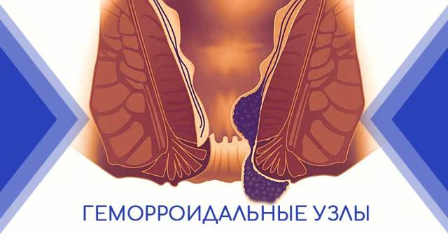 Мазь Постеризан от геморроя: показания, принцип действия, отзывы, аналоги и цены