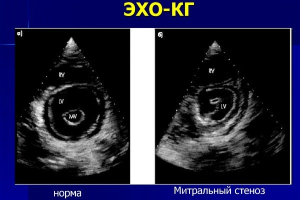 Эхо КГ сердца что это такое, как делают