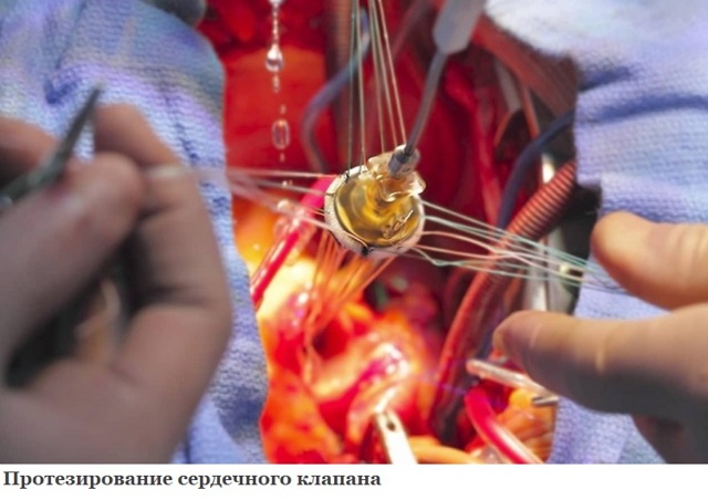 Приобретенный порок сердца
