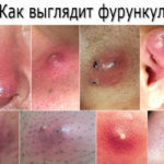 Проблемы с кожей при диабете 2 типа