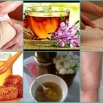 Народные средства от тромбофлебита нижних конечностей: травы, мед, лечение в домашних условиях