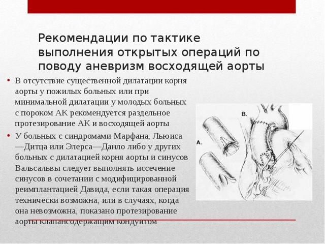 Лечение аневризмы брюшной аорты, операция аневризмы брюшной полости: цена в СПб.
