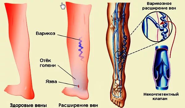 ВАЗОКЕТ - инструкция по применению, цена, отзывы и аналоги