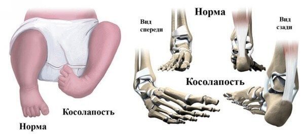 От чего возникает косолапость у детей и как ее эффективно лечить