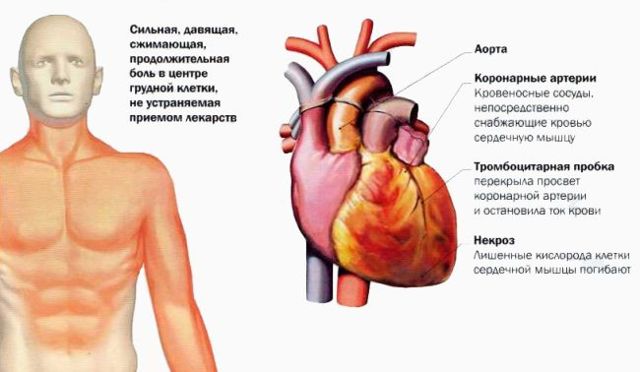 Острый инфаркт миокарда: причины, симптомы, осложнения болезни, диагностика и лечение
