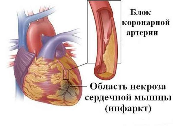 Сколько лежат в реанимации после инфаркта и на сколько дней дают больничный