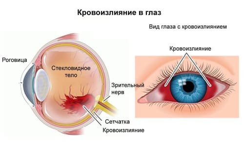 От чего лопаются сосуды в глазах: причины и профилактика