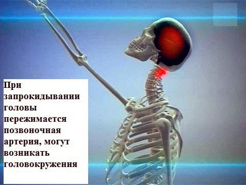 Синдром позвоночной артерии – причины, симптомы, лечение, упражнения при синдроме позвоночной артерии