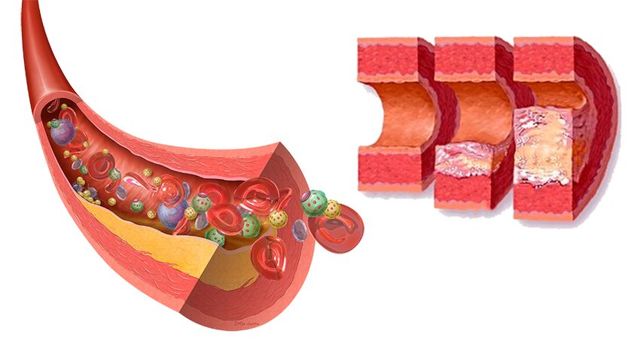 Холестерин плохой и хороший - опасность и норма у женщин