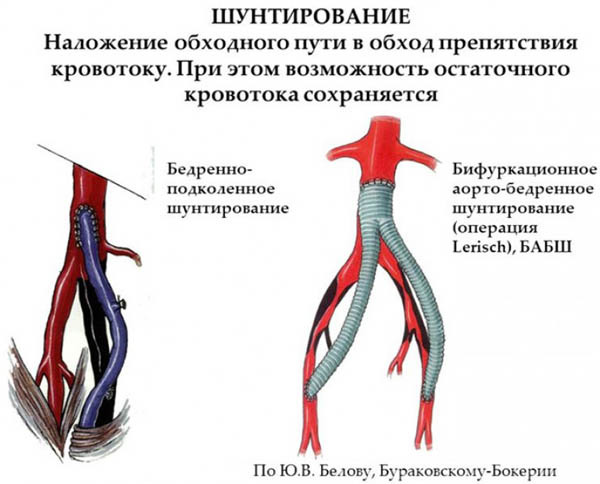 Операция по чистке сосудов нижних конечностей