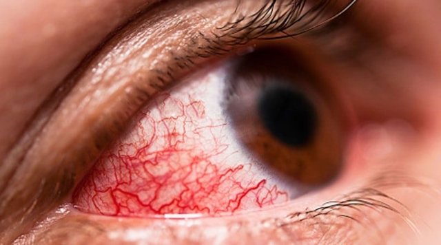 От чего лопаются сосуды в глазах: причины и профилактика