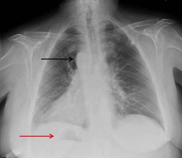 Декстрокардия: как жить с сердцем справа?