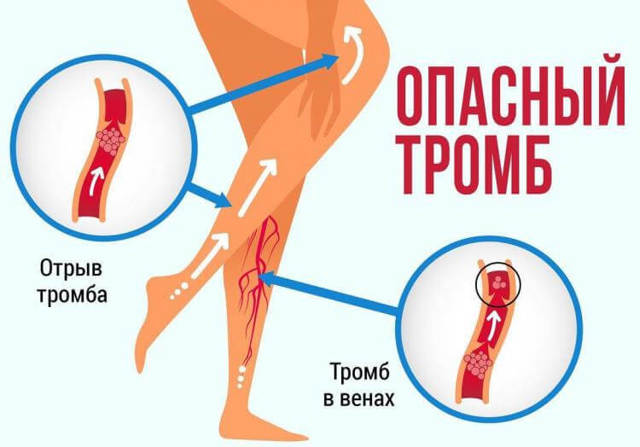 Почему оторвался тромб? Причины, симптомы и что делать?
