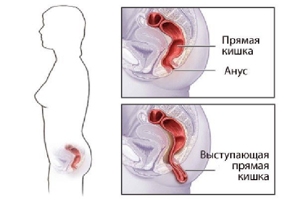 Слабительные свечи при запорах у взрослых быстрого действия